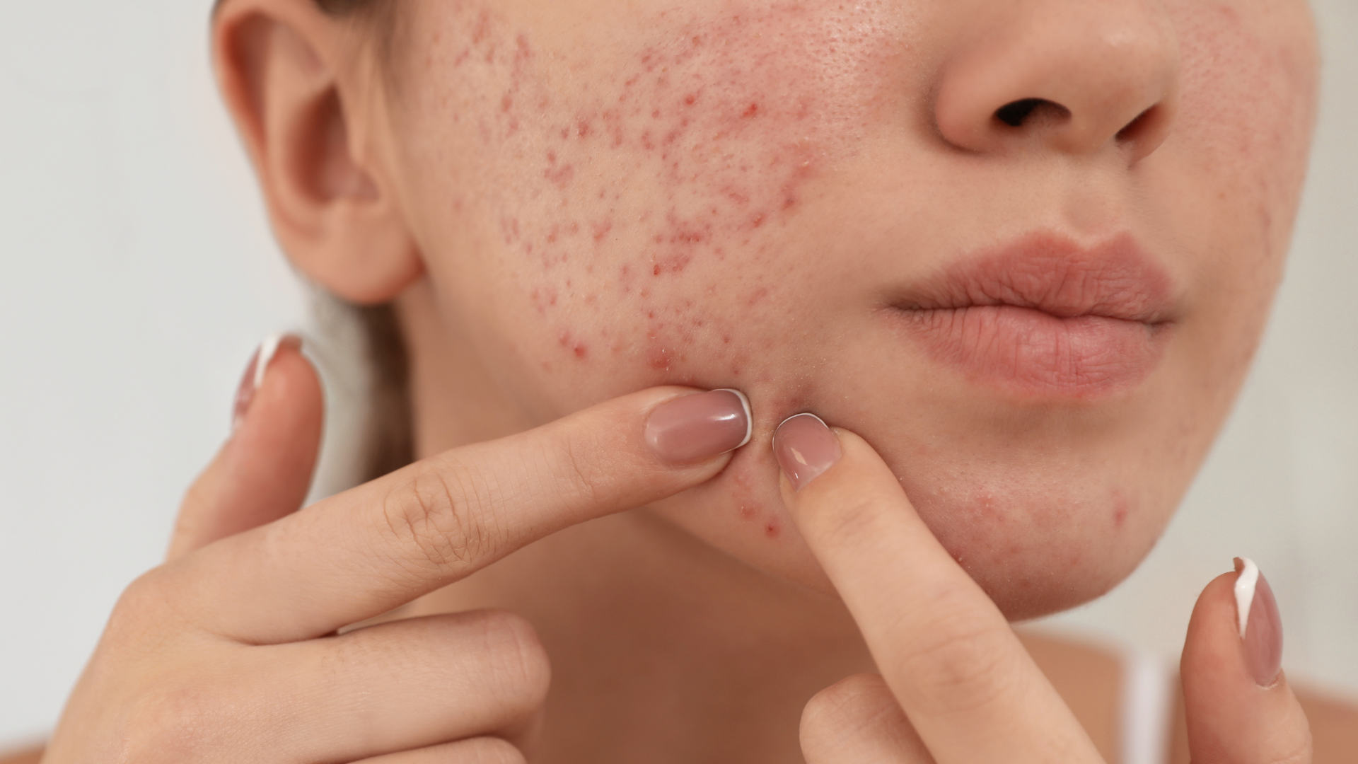 Spotless: Magnesium for Acne